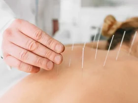 What Is Acupuncture and How Can It Improve Your Health?